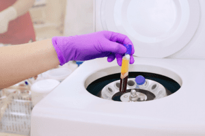 Whole blood separated by centrifugation during fresh frozen plasma preparation before storage 